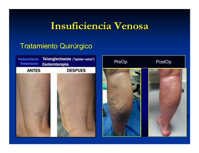 insuficiencia venosa periferica